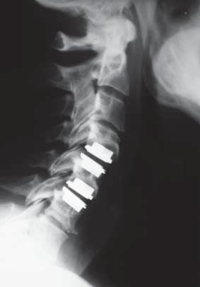 58 M. TĘSIOROWSKI, E. LIPIK, D. ZARZYCKI, T. POTACZEK, B. JASIEWICZ, K. ŁOKAS posterior edge of the vertebral body of the neighboring vertebrae.