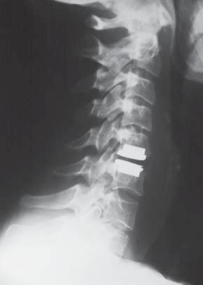 This allows the lumen of the vertebral canal to be restored, the pressure upon the nerve structures to be relieved, as well as for a restoration of the proper height of the disc space and a