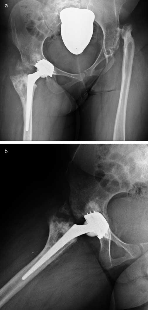 W pierwszej dobie pooperacyjnej wykonywano kontrolne badanie radiologiczne (ryc.