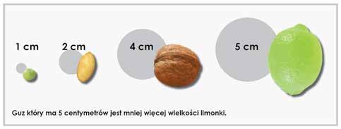 są obecne w sąsiadujących węzłach chłonnych lub nowotwór ma 5-7 cm średnicy i komórki nowotworu nie występują w węzłach chłonnych.