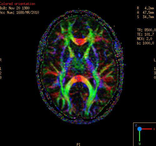 Wynik badania DTI mapy parametryczne kolorowa FA przedstawia główny kierunek dyfuzji, mapa RGB :