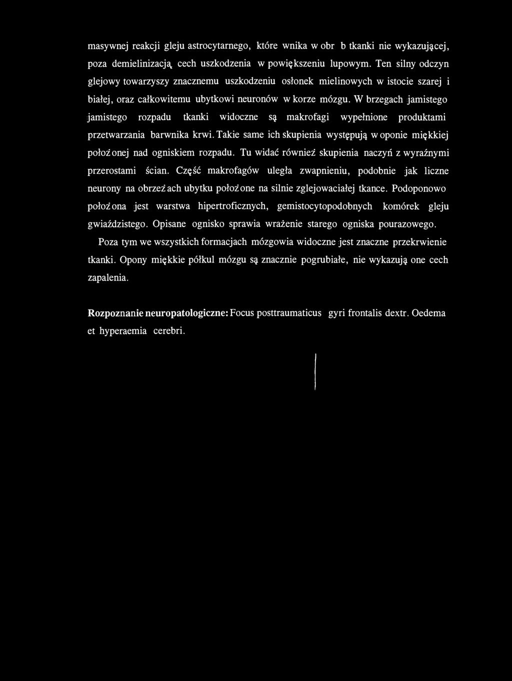 W brzegach jamistego jamistego rozpadu tkanki widoczne są makrofagi wypełnione produktami przetwarzania barwnika krwi.