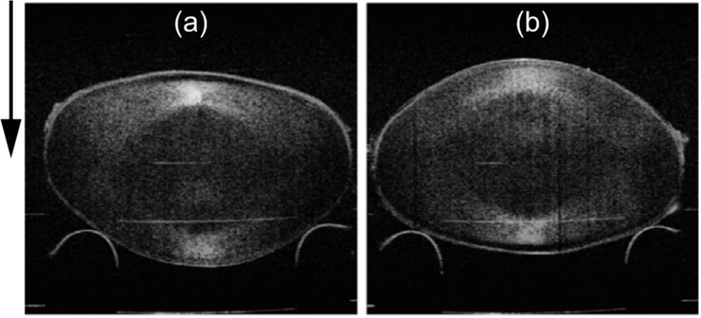 dr inż. Damian Siedlecki: Rysunek 5 Obrazy OCT tej samej soczewki ocznej in vitro zarejestrowane w konfiguracji Anterior-up (a i c) oraz w konfiguracji Posterior-up (b i d).