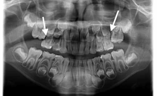 Ectopic eruption of permanent maxillary first molars - a review and a case report to możemy zastosować separatory elastyczne w przeciwnym wypadku stosujemy separację opartą na metalowym drucie jako