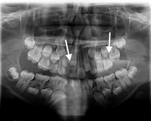 K. Becker et al. Ryc. 3. Zdjęcie OPG pacjentki w wieku 8 lat z ektopowym wyrzynaniem zęba 26 oraz opóźnionym wyrzynaniem zęba 11. Fig. 3. Panoramic radiograph of female patient at 8 years of age with ectopic eruption of tooth 26 and delayed eruption of tooth 11.