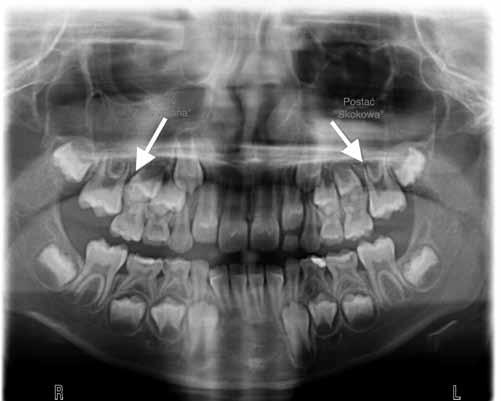 Zdjęcie OPG pacjentki w wieku 7 lat, resorpcja podminowująca zębów 16 i 26; ząb 26 wyżnął się samoistnie, natomiast 16 wymagał chirurgicznego odsłonięcia i leczenia ortodontycznego. Fig. 4.
