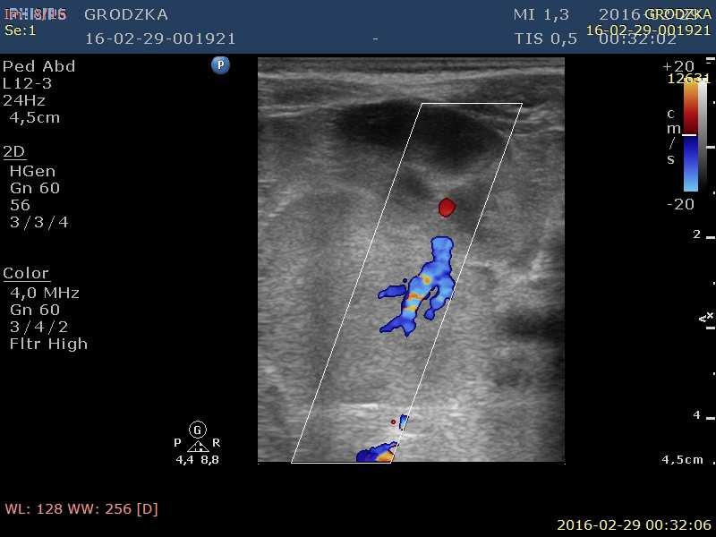 Nieprawidłowości w badaniu USG Guzy-neuroblastoma-2 Torbiele jajnika <2 cm 13 Torbiele śledziony -2 Torbiel dróg żółciowych -1 Torbiel wątroby-1, Naczyniak wątroby
