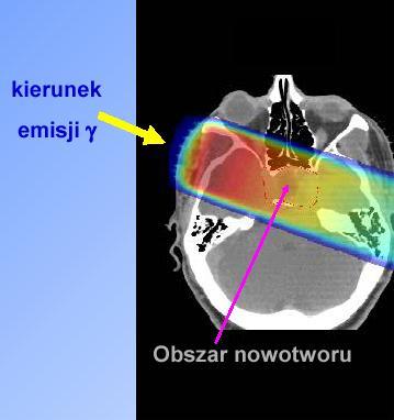 Akcelerator medyczny Do terapii używa się wiązki