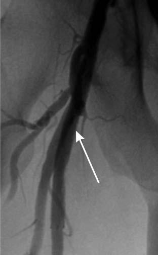 Wynik końcowy, dystalny odcinek tętnicy udowej i tętnica podkolanowa, projekcja AP jednakże w trakcie ok.