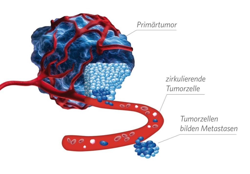 Powstawanie przerzutów nowotworowych Carcinoma = rak-synonim nowotworów złośliwych pochodzenia