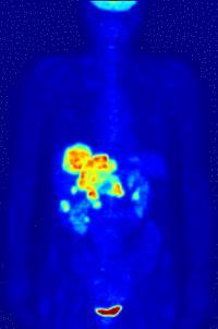 Inne zastosowania PET Rozmieszczenie receptorów określonych neurotransmitterów