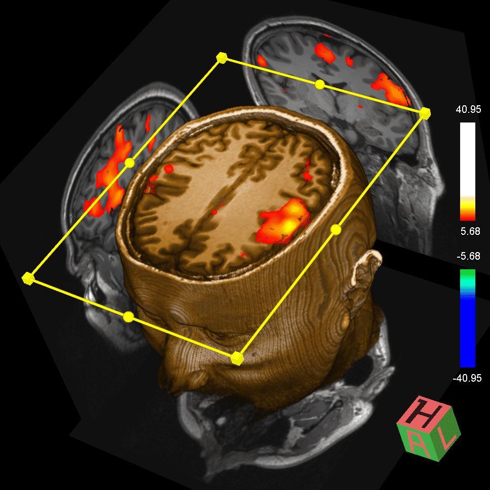 strukturalne MRI w postaci