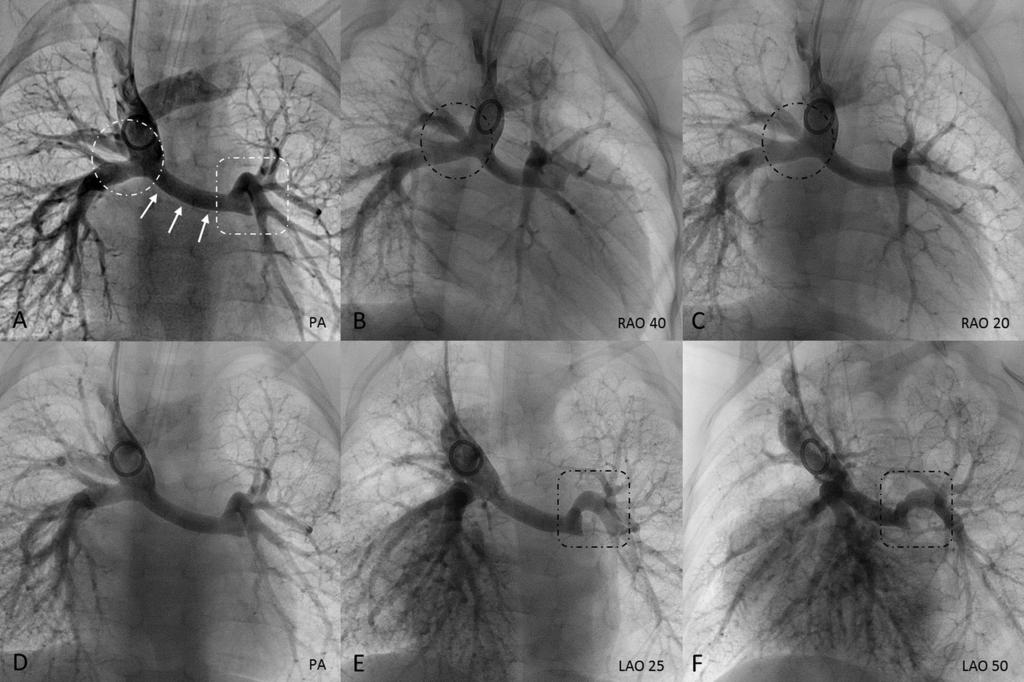 Folia Cardiologica 2015, tom 10, nr 1 Rycina 1A. Standardowa angiografia, projekcja tylno-przednia (PA, postero-anterior).