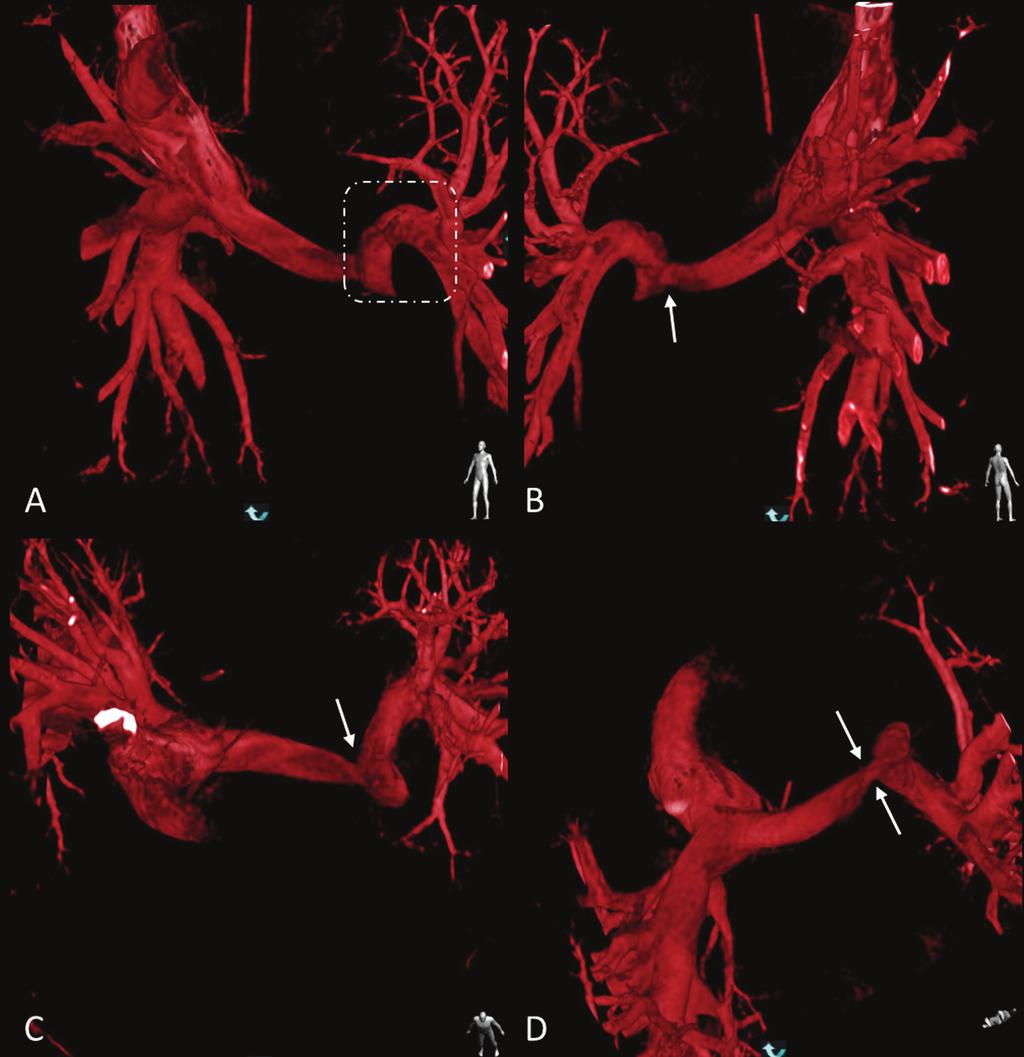 Sebastian Góreczny i wsp., Implantacja stentu monitorowana za pomocą 3DRA Rycina 2. Trójwymiarowa rekonstrukcja tętnic płucnych na podstawie angiografii rotacyjnej.
