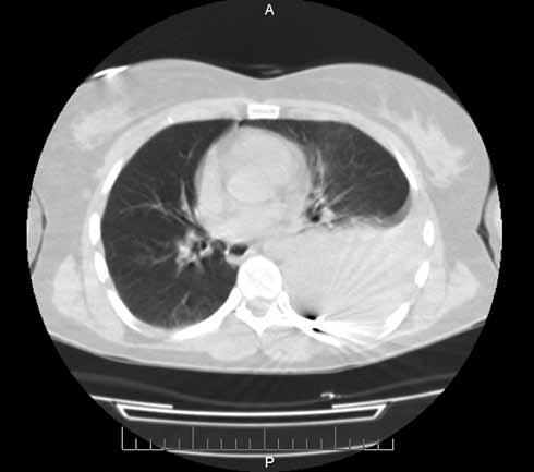 Ponadto stwierdzono cechy krwiaka w okolicy śródpiersia górnego po stronie lewej (ryc. 4, 5, 6). Ryc. 4. Lokalizacja pocisku, obraz tomografii komputerowej. Fig. 4. Localization of the pellet, a CT scan.