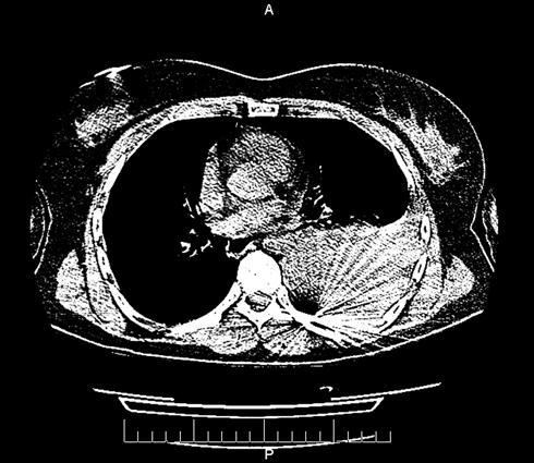 Nr 2-3 POSTRZAŁ Z BRONI PNEUMATYCZNEJ 135 Ryc. 6. Lokalizacja pocisku, obraz tomografii komputerowej. Fig. 6. Localization of the pellet, a CT scan.