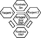 Rys. 1: Brak identyfikacji Rys. 2: Identyfikacja Sm Rys. 3: Identyfikacja Sm i RNP Linia precypityny pacjenta 1 krzyżuje się lub wykazuje brak identyfikacji z kontrolami Sm oraz RNP.