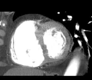 Przykładowy problem Diagnostyka zatorowości płucnej Obrazowanie CT sprzężone z aparatem do EKG (sekwencja wideo 3D) Rekonstrukcja przekrojów wzdłuż długiej osi serca
