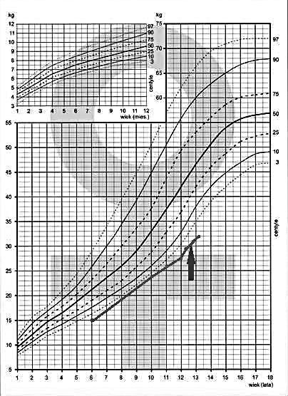 Siatka centylowa masy ciała pacjentki Fig. 2. The patient s body mass curves on percentile weight charts nia, niewielki wytrzeszcz obu gałek ocznych oraz tachykardię do 130 /min.