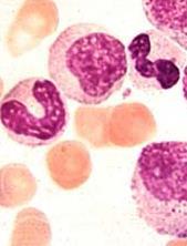 Przewlekła białaczka szpikowa (CML Chronic Myeloid Leukemia): wynik mutacji hematopoetycznych komórek macierzystych szpiku kostnego stanowi ok.