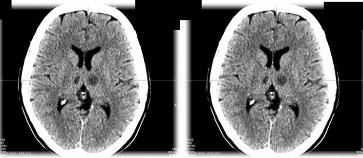 Polski Przegląd Neurologiczny, 2016, tom 12, nr 3 A B Rycina 2A, B.