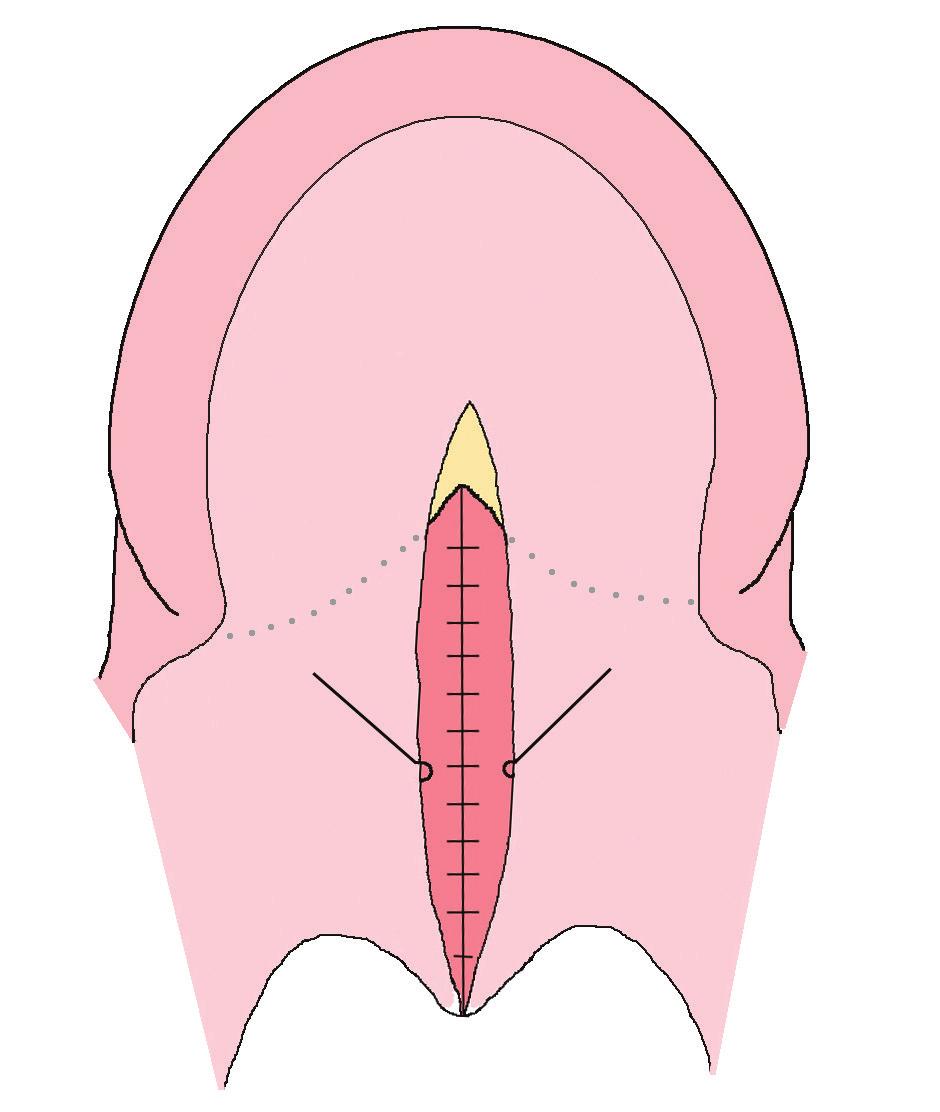 a) Technika chirurgiczna w grupie poddanej radykalnej wewnątrzpodniebiennej plastyce podniebienia miękkiego (RIVVP) Przeprowadzono wewnątrzpodniebienną plastykę podniebienia miękkiego typu II,