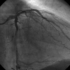 Severe stenosis with thrombus in medial left anterior descending coronary artery in