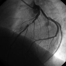 Severe stenosis in medial segment of the left anterior descending coronary artery in