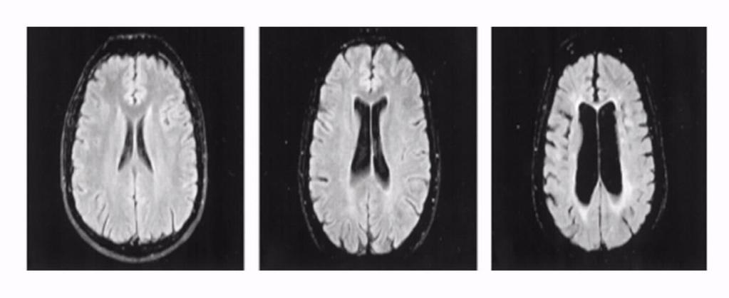 Wczesna i skuteczna terapia SM jest kluczowa dla opóźnienia nieodwracalnego uszkodzenia neurologicznego Uszkodzenie mózgu w SM prowadzi do nieodwracalnej utraty masy tkankowej Naturalna rezerwa