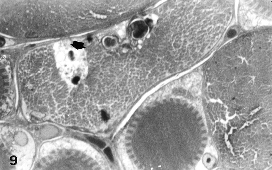 Rys. 7. swzm Beta-amyloidopozytywne wtrêty we w³óknie miêœniowym x 1050 tury tubulofilamentarne w cytoplazmie i j¹drach komórek miêœniowych.