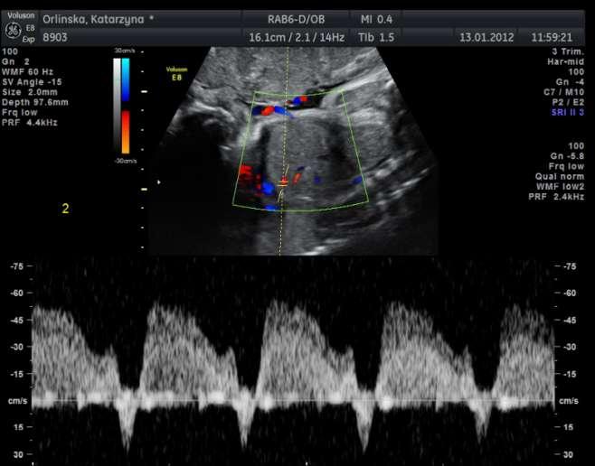 ULTRASONOGRAFICZNE BADANIE DOPPLEROWSKIE Przewód żylny Ductus Venosus -