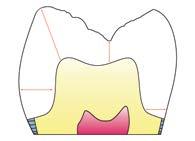 VITA SUPRINITY PC Wytyczne dotyczące preparacji zębów* 1,0 mm 1,5 mm Korony odcinka przedniego Preparacja z rowkiem półokrągłym jest prosta i bardzo łagodna dla substancji zęba.