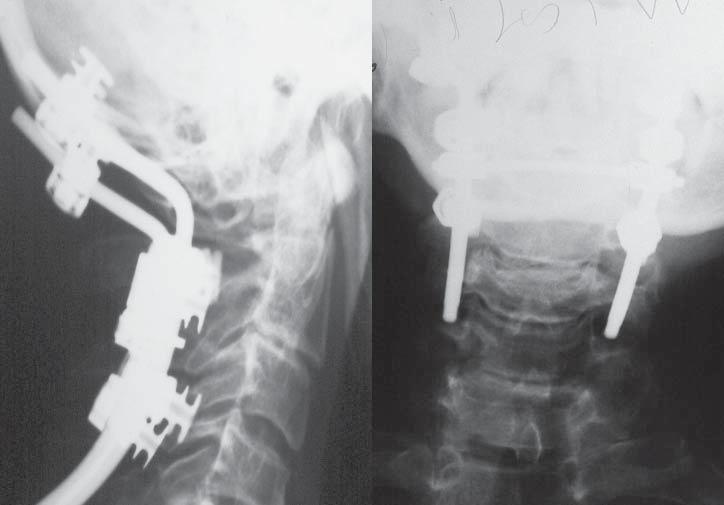 Occipito-cervical fusion using some types of implants anchors in the cranio-cervical pathologies 41 From the typical posterior access, after exposuring the bone of occiput and arches of upper