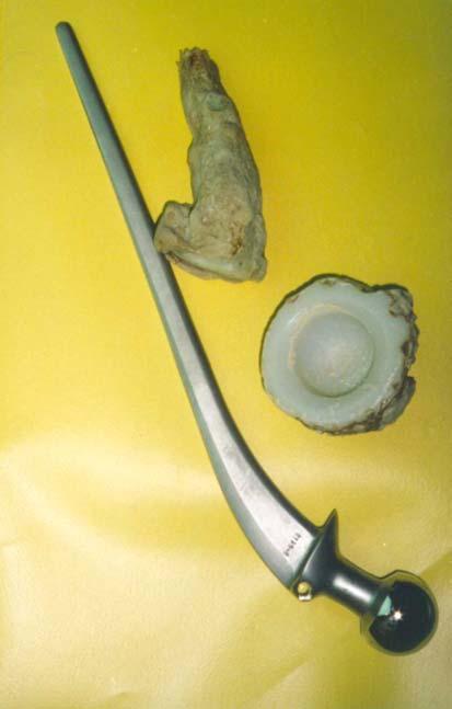 114 T R I B O L O G I A 4-2003 Rys. 1 b Usunięta endoproteza Wellera wraz z fragmentem cementu. Fig. 1b. Weller endoprosthesis removed and a fragment of cement.