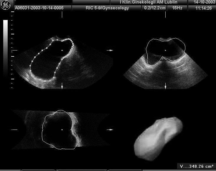 Ultrasonografia w diagnostyce przyczyn nietrzymania moczu u kobiet po menopauzie Ryc. 1. Sposób pomiaru objętości pęcherza w trójwymiarowej ultrasonografii.