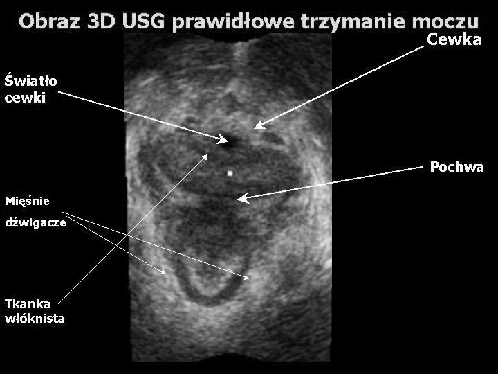 Z założenia wiemy, że badany pęcherz moczowy zwykle nie pozwala się obrysować elipsą i tu przychodzi z pomocą ocena VOCAL w 3D USG.