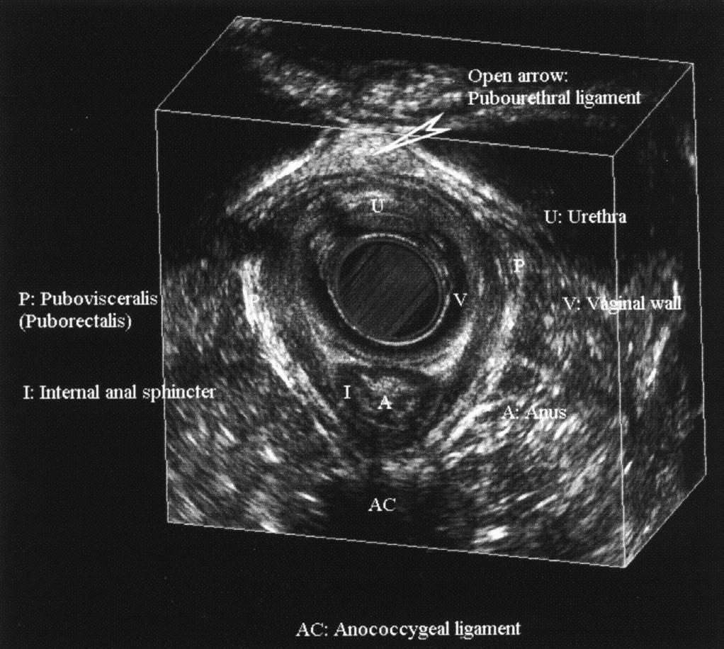 Ultrasonografia w diagnostyce przyczyn nietrzymania moczu u kobiet po menopauzie Ryc. 9. Przykład pomiaru kąta między ramionami mięśni dźwigaczy odbytu.
