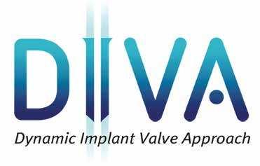 _informacje rynkowe Innowacyjna metoda podnoszenia dna zatoki szczękowej (Sinus Lift) _Diva to nowe rozwiązanie do wykonania zabiegu Sinus Lift za pomocą implantów zatokowych.