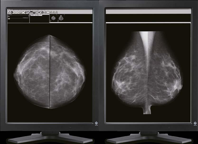 Zamień klisze na cyfrowe obrazy mammograficzne Ze względu na znaczny wzrost liczby zachorowań na raka piersi, zalecane jest regularne wykonywanie badań mammograficznych.