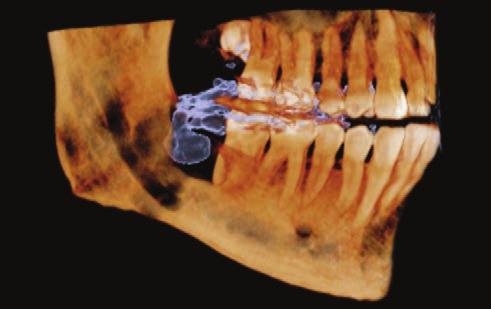 5 x ø 5 cm Diagnostyka punktowa: Planowanie pojedynczych implantów