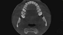 Rozdzielczość endodontyczna umożliwia skanowanie