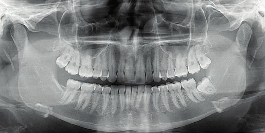 Programy dopasowane do potrzeb klinicznych Aby sprostać potrzebom praktyk o szerokim zakresie usług, OP 3D oferuje protokoły standardowe, pediatryczne i panoramiczne z segmentacją, boczne projekcje