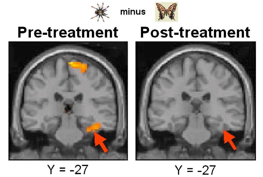 Change the mind and you will change the brain: effects of cognitive behavioral therapy