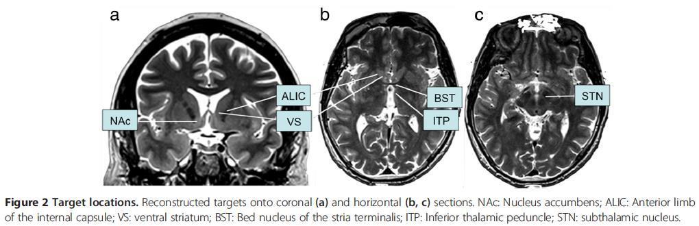 Deep Brain Stimulation for Treatment- Refractory Obsessive Compulsive