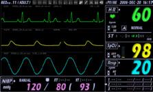 krzywymi na ekranie Standardowa konfiguracja: EKG, SpO 2, NIBP, Oddech, Temp 6 ekranów wirtualnych Możliwość pełnej analizy do 7