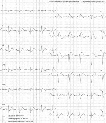 Zapis 12-odprowadzeniowego EKG u 26-letniej pacjentki po podaniu ajmaliny dożylnie (fragment zapisu EKG metodą Holtera). Zapis 25 mm/s.
