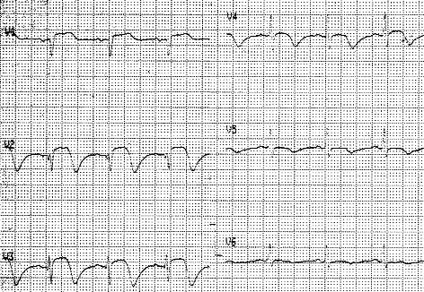 812 Anna Tomaszuk-Kazberuk et al. Rycina 3. EKG po ostatniej interwencji z powodu niewielkiej dyssekcji.