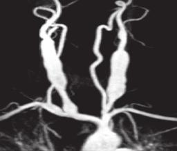 Magdalena Bujak, Katarzyna Mazur, Postępy w diagnostyce obrazowej tętnic dogłowowych Rycina 5.