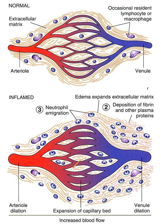 Fizjologia stanu zapalnego tkanka uwalnia chemiczne sygnały po zakażeniu lub uszkodzeniu tkanki, - przepuszczalność naczyń, - czynniki chemotaktyczne.