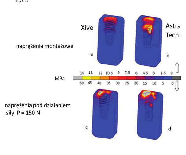 Dla implantu Xive naprężenie wstępne wokół implantu wynosi około 13,5 MPa a dla implantu Astra Tech. 8,5 MPa.